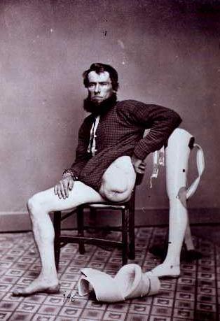 En vellykket benamputeret med sin protese (1868)